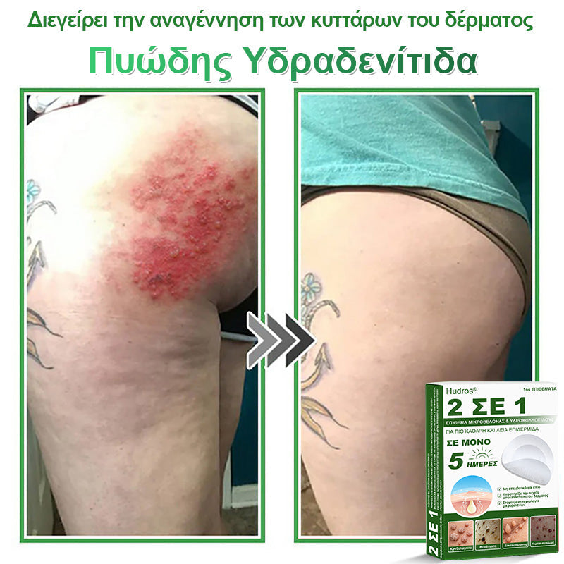 𝐇𝐮𝐝𝐫𝐨𝐬® 📌𝟐-σε-𝟏 υδροκολλοειδή επιθέματα με μικροβελόνες | 🧪Ειδικά σχεδιασμένα για την αφαίρεση υπερυψωμένων σπίλων, ακμής, επίπεδων μυρμηγκιών και δερματικών μορφωμάτων | Συσκευασία 𝟏𝟒𝟒 τεμαχίων🌴🌴