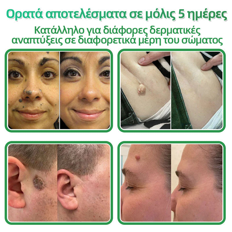 𝐇𝐮𝐝𝐫𝐨𝐬® 📌𝟐-σε-𝟏 υδροκολλοειδή επιθέματα με μικροβελόνες | 🧪Ειδικά σχεδιασμένα για την αφαίρεση υπερυψωμένων σπίλων, ακμής, επίπεδων μυρμηγκιών και δερματικών μορφωμάτων | Συσκευασία 𝟏𝟒𝟒 τεμαχίων🌴🌴
