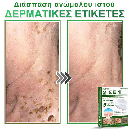 𝐇𝐮𝐝𝐫𝐨𝐬® 📌𝟐-σε-𝟏 υδροκολλοειδή επιθέματα με μικροβελόνες | 🧪Ειδικά σχεδιασμένα για την αφαίρεση υπερυψωμένων σπίλων, ακμής, επίπεδων μυρμηγκιών και δερματικών μορφωμάτων | Συσκευασία 𝟏𝟒𝟒 τεμαχίων🌴🌴