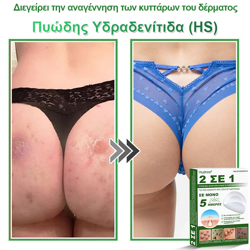 𝐇𝐮𝐝𝐫𝐨𝐬® 📌𝟐-σε-𝟏 υδροκολλοειδή επιθέματα με μικροβελόνες | 🧪Ειδικά σχεδιασμένα για την αφαίρεση υπερυψωμένων σπίλων, ακμής, επίπεδων μυρμηγκιών και δερματικών μορφωμάτων | Συσκευασία 𝟏𝟒𝟒 τεμαχίων🌴🌴