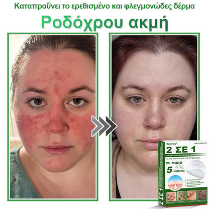 𝐇𝐮𝐝𝐫𝐨𝐬® 📌𝟐-σε-𝟏 υδροκολλοειδή επιθέματα με μικροβελόνες | 🧪Ειδικά σχεδιασμένα για την αφαίρεση υπερυψωμένων σπίλων, ακμής, επίπεδων μυρμηγκιών και δερματικών μορφωμάτων | Συσκευασία 𝟏𝟒𝟒 τεμαχίων🌴🌴