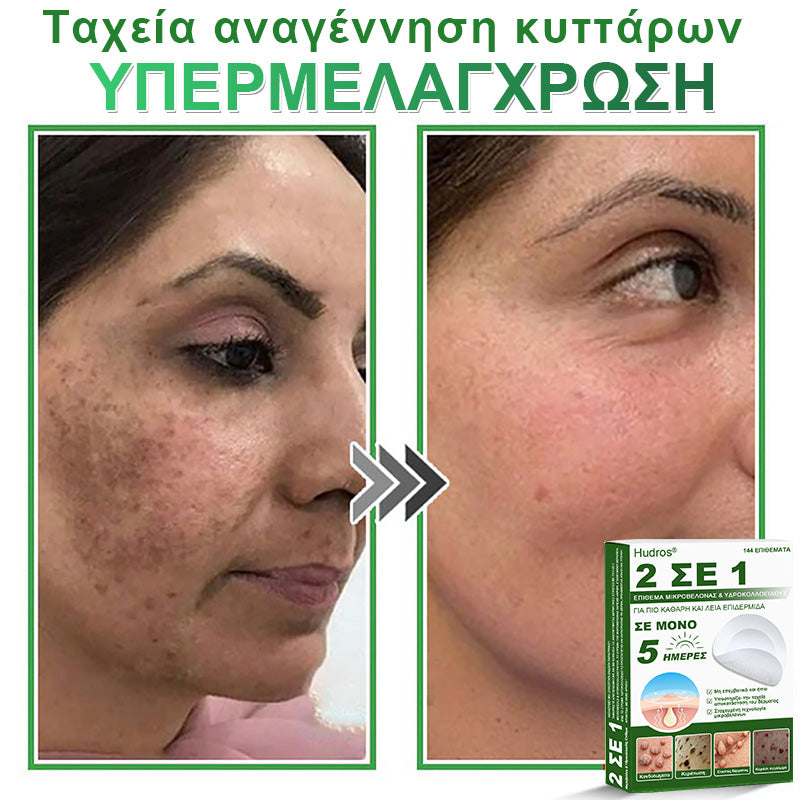 𝐇𝐮𝐝𝐫𝐨𝐬® 📌𝟐-σε-𝟏 υδροκολλοειδή επιθέματα με μικροβελόνες | 🧪Ειδικά σχεδιασμένα για την αφαίρεση υπερυψωμένων σπίλων, ακμής, επίπεδων μυρμηγκιών και δερματικών μορφωμάτων | Συσκευασία 𝟏𝟒𝟒 τεμαχίων🌴🌴