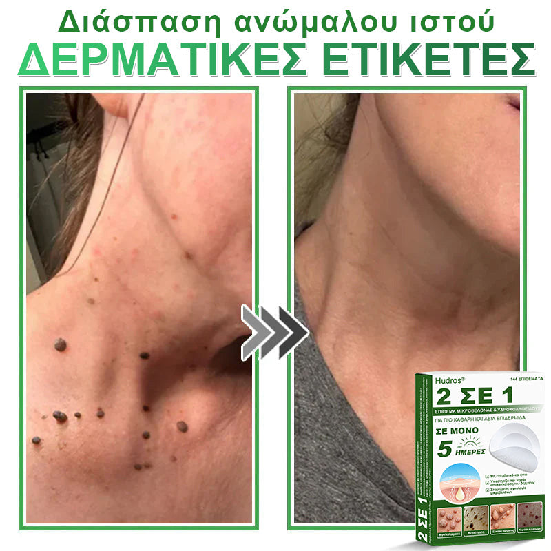 𝐇𝐮𝐝𝐫𝐨𝐬® 📌𝟐-σε-𝟏 υδροκολλοειδή επιθέματα με μικροβελόνες | 🧪Ειδικά σχεδιασμένα για την αφαίρεση υπερυψωμένων σπίλων, ακμής, επίπεδων μυρμηγκιών και δερματικών μορφωμάτων | Συσκευασία 𝟏𝟒𝟒 τεμαχίων🌴🌴