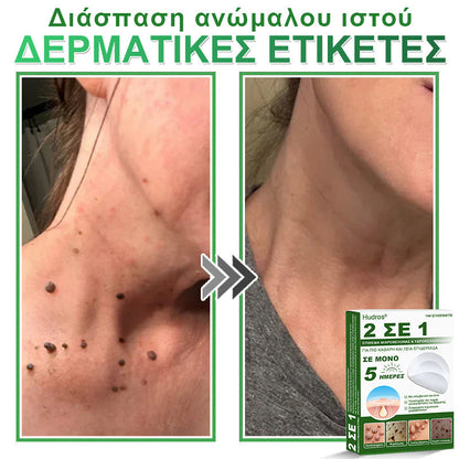 𝐇𝐮𝐝𝐫𝐨𝐬® 📌𝟐-σε-𝟏 υδροκολλοειδή επιθέματα με μικροβελόνες | 🧪Ειδικά σχεδιασμένα για την αφαίρεση υπερυψωμένων σπίλων, ακμής, επίπεδων μυρμηγκιών και δερματικών μορφωμάτων | Συσκευασία 𝟏𝟒𝟒 τεμαχίων🌴🌴