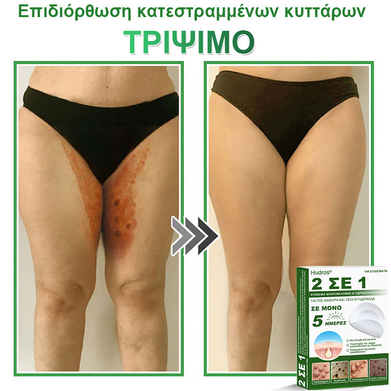 𝐇𝐮𝐝𝐫𝐨𝐬® 📌𝟐-σε-𝟏 υδροκολλοειδή επιθέματα με μικροβελόνες | 🧪Ειδικά σχεδιασμένα για την αφαίρεση υπερυψωμένων σπίλων, ακμής, επίπεδων μυρμηγκιών και δερματικών μορφωμάτων | Συσκευασία 𝟏𝟒𝟒 τεμαχίων🌴🌴