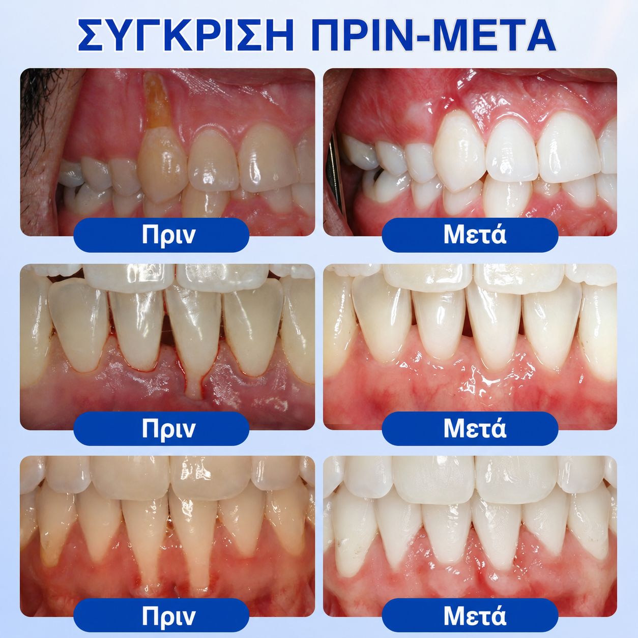 🇬🇷👨‍⚕️✅🦷HEATWOLF® GumRevive Γέλη Επιδιόρθωσης Περιοδοντίτιδας🍿